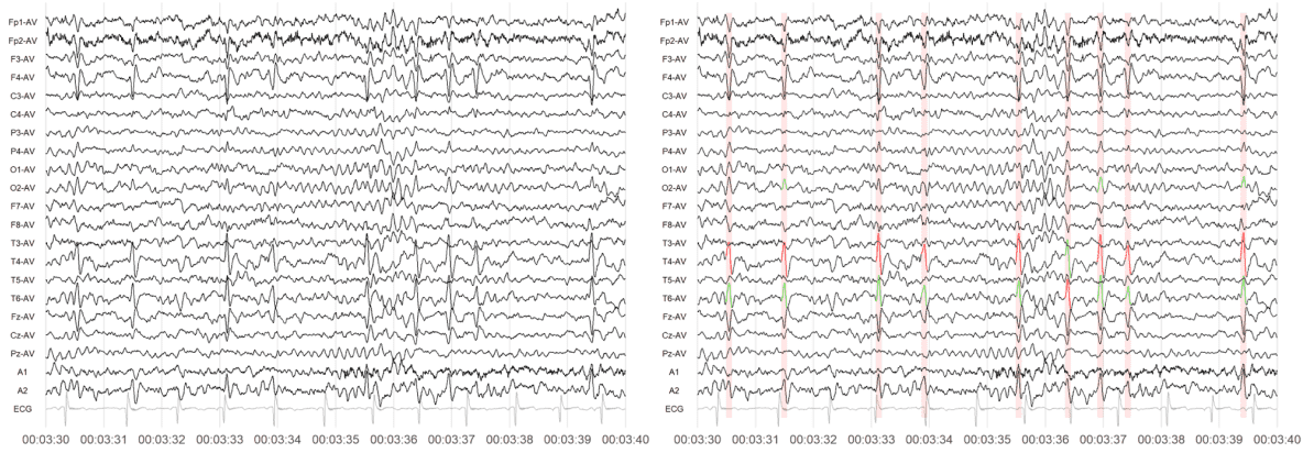 Spike/Wave Detection